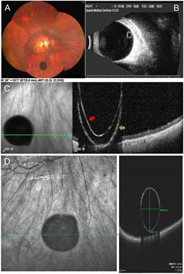 Case report: Characterizing of free-floating pigmented vitreous cyst using swept-source optical coherence tomography